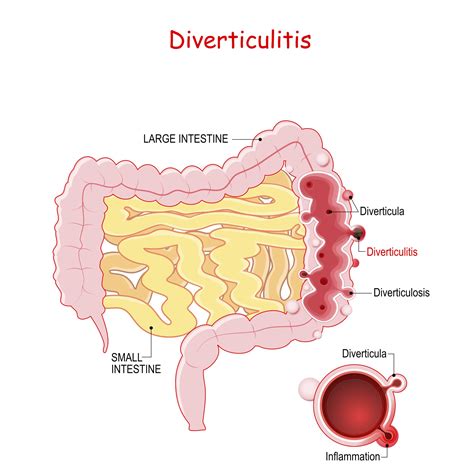 diverticulitis diagram|pictures of diverticulosis disease.